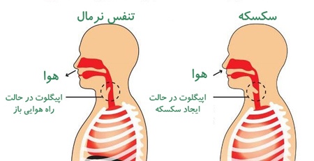 دانستنی های مهم سکسکه